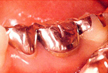 銀歯の落とし穴